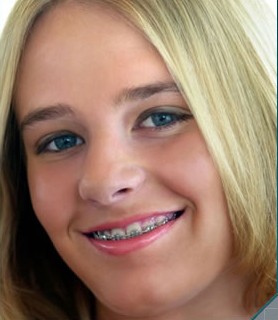 Kissing With Braces 